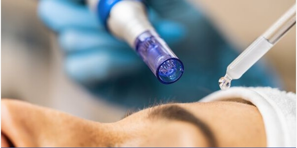Microneedling