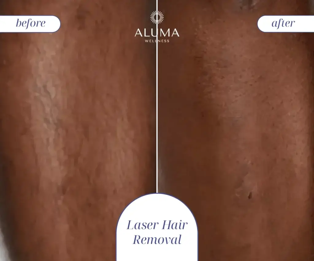 Laser hair removal-01