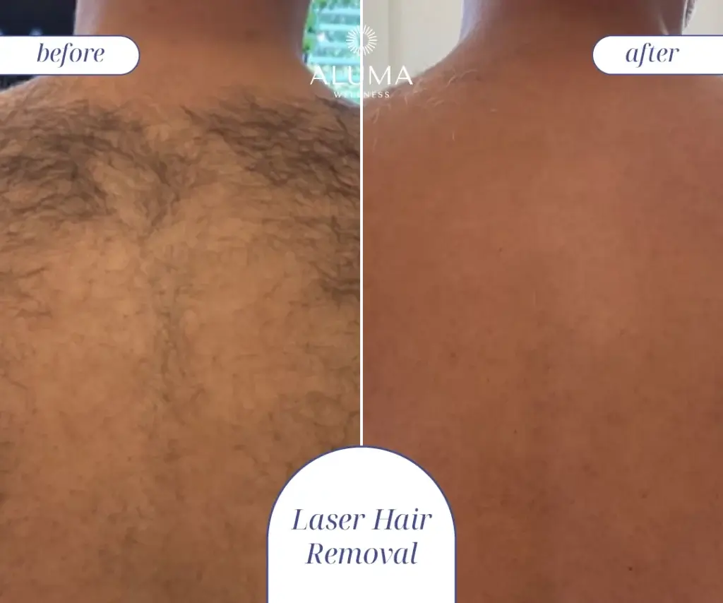 Laser hair removal-02